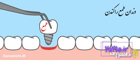 ضرب المثل دندان طمع را کندن